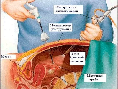 Мрт малого таза у жінок що показує (таза) Мрт малого таза у жінок що показує