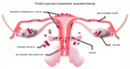 Мрт малого таза у жінок що показує (жінок) Мрт малого таза у жінок що показує