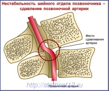 Нестабільність шийного відділу хребта у дітей (дітей) Нестабільність шийного відділу хребта у дітей