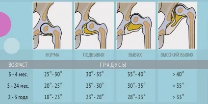 Одна нога коротша за іншу у дитини, причини, лікування, наслідки, бебіклад (причини) Одна нога коротша за іншу у дитини, причини, лікування, наслідки, бебіклад