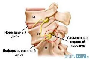 Оніміння кінцівок ніг, рук, під час сну, при неврозі, причини, симптоми (причини) Оніміння кінцівок ніг, рук, під час сну, при неврозі, причини, симптоми