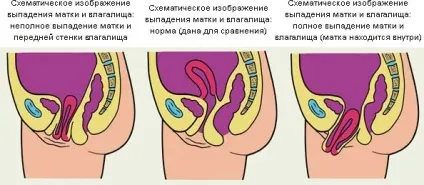 Опущення матки причини, симптоми, наслідки для способу життя (матки) Опущення матки причини, симптоми, наслідки для способу життя