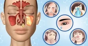 Особливості лікування синуситу причини і симптоми, ніж лікувати синусит у дорослих (симптоми) Особливості лікування синуситу причини і симптоми, ніж лікувати синусит у дорослих
