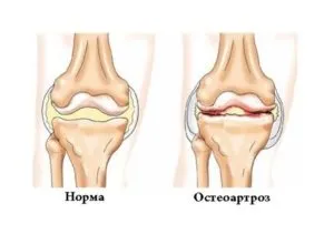 Остеоартрозу хребта симптоми і лікування, великих периферичних суглобів