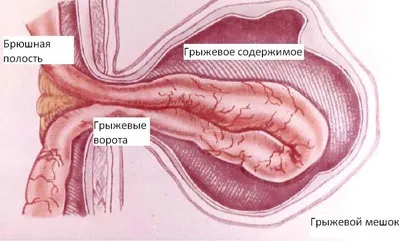 Від чого збільшується грижа причини патології (чого) Від чого збільшується грижа причини патології