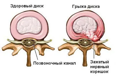 Від чого збільшується грижа причини патології (причини) Від чого збільшується грижа причини патології