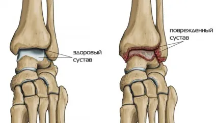 Остеоартроз гомілковостопного суглоба симптоми, ступеня і лікування (гомілковостопного) Остеоартроз гомілковостопного суглоба симптоми, ступеня і лікування