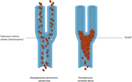 Гострий і глибокий венозний тромбоз профілактика, класифікація, симптоми, фото (артеріальні і венозні тромбози) Гострий і глибокий венозний тромбоз профілактика, класифікація, симптоми, фото