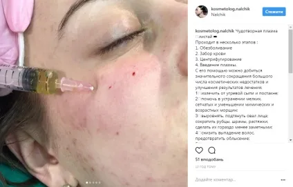 Особливості проведення биоревитализации (биоревитализации) Особливості проведення биоревитализации