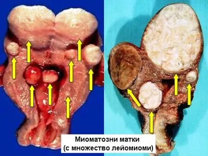 Відмінності лейоміоми матки і міоми (лейоміоми) Відмінності лейоміоми матки і міоми