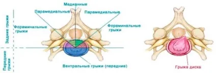 Парамедіанна грижа диска l5-s1, інші парамедіальний грижі і їх лікування (диска) Парамедіанна грижа диска l5-s1, інші парамедіальний грижі і їх лікування