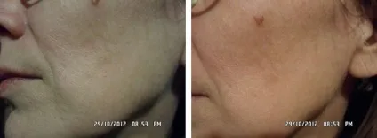 Пептидная мезотерапія dermaheal meso знайомимося з препаратами лінії (dermaheal) Пептидная мезотерапія dermaheal meso знайомимося з препаратами лінії