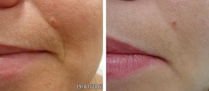 Пептидная мезотерапія dermaheal meso знайомимося з препаратами лінії (meso) Пептидная мезотерапія dermaheal meso знайомимося з препаратами лінії