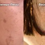 Пігментні плями на тілі особливості, причини, види, лікування (особливо) Пігментні плями на тілі особливості, причини, види, лікування