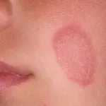 Пігментні плями на тілі особливості, причини, види, лікування (пігментні) Пігментні плями на тілі особливості, причини, види, лікування