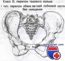Переломи тазового кільця без зміщення лобковихкісток