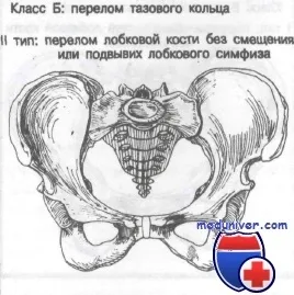 Переломи тазового кільця без зміщення лобковихкісток