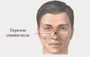 Перелом носа ознаки, симптоми, як зрозуміти що зламаний (симптоми) Перелом носа ознаки, симптоми, як зрозуміти що зламаний