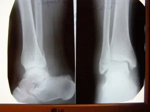 Перелом голеностопа що потрібно знати потерпілому