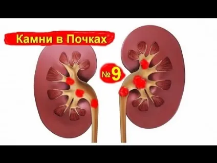 Пісок в нирках симптоми і лікування у чоловіків народними засобами в домашніх умовах, дієта (лікування) Пісок в нирках симптоми і лікування у чоловіків народними засобами в домашніх умовах, дієта