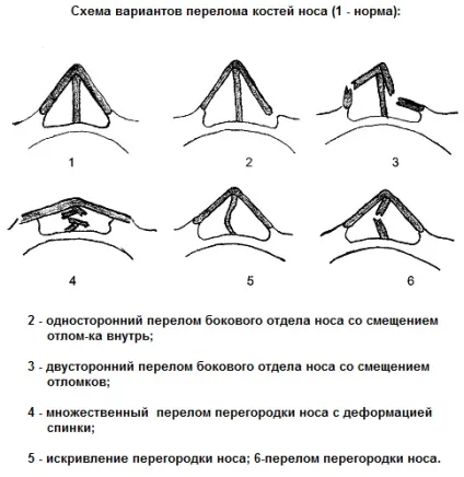 Перелом носа ознаки, симптоми, як зрозуміти що зламаний (ознаки) Перелом носа ознаки, симптоми, як зрозуміти що зламаний