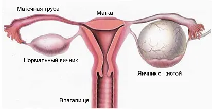 Чому болять яєчники при вагітності на ранніх термінах і пізніх термінах, тягне яєчник (ранніх) Чому болять яєчники при вагітності на ранніх термінах і пізніх термінах, тягне яєчник