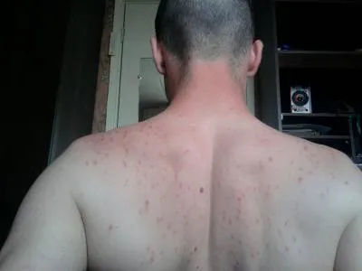 Чому у хлопців прищі на спині (хлопець) Чому у хлопців прищі на спині