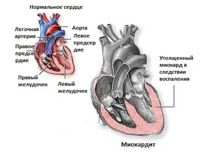 Чому виникає тупий біль в області серця і як її лікувати (тупий біль область серця ниючий) Чому виникає тупий біль в області серця і як її лікувати