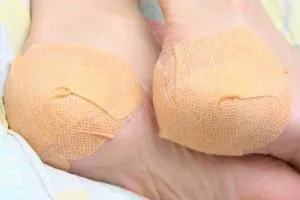 Як лікувати грибок на п'ятах ніг симптоми, причини, профілактика (грибок) Як лікувати грибок на п'ятах ніг симптоми, причини, профілактика