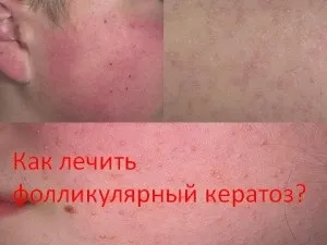 Як лікувати фолікулярний кератоз, мій знахар (кошти від кератоза) Як лікувати фолікулярний кератоз, мій знахар