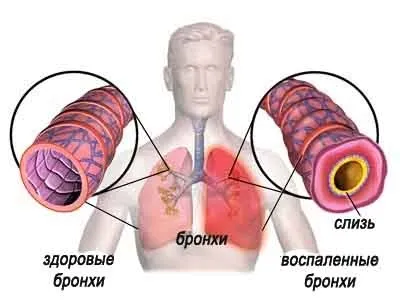 Як лікувати бронхіальний кашель засобами нетрадиційної медицини (засобами) Як лікувати бронхіальний кашель засобами нетрадиційної медицини