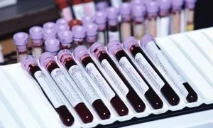 Показники алт і аст у чоловіків норма і відхилення, підготовка і здача аналізу, співвідношення (чоловіків) Показники алт і аст у чоловіків норма і відхилення, підготовка і здача аналізу, співвідношення