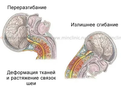 Підвивих хребця симптоми, ознаки, діагностика та лікування (профілактика і підвивих хребця) Підвивих хребця симптоми, ознаки, діагностика та лікування
