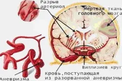 Наслідки аритмії серця