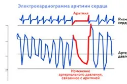 Наслідки аритмії серця