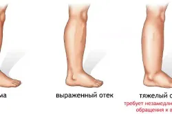 Наслідки аритмії серця