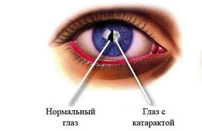 Користь і шкода зубної пасти з фтором або без фтору (фтором) Користь і шкода зубної пасти з фтором або без фтору