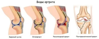 Посттравматичний артрит причини, симптоми, лікування