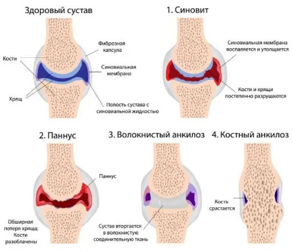 Посттравматичний артрит причини, симптоми, лікування
