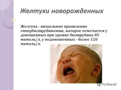 Презентація на тему диференціальна діагностика неонатальних жовтяниць виконала мельчукова владлена (диференціальна) Презентація на тему диференціальна діагностика неонатальних жовтяниць виконала мельчукова владлена