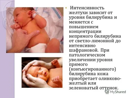 Презентація на тему диференціальна діагностика неонатальних жовтяниць виконала мельчукова владлена (неонатальних) Презентація на тему диференціальна діагностика неонатальних жовтяниць виконала мельчукова владлена