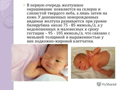 Презентація на тему диференціальна діагностика неонатальних жовтяниць виконала мельчукова владлена (неонатальних) Презентація на тему диференціальна діагностика неонатальних жовтяниць виконала мельчукова владлена