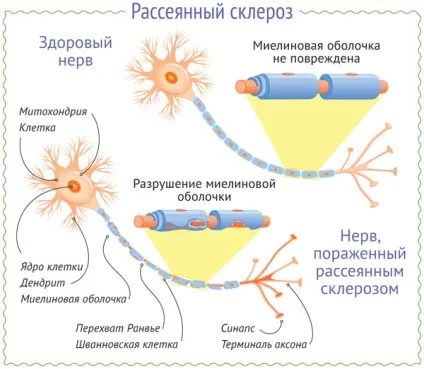 Причини розсіяного склерозу - чи передається у спадок (склерозу) Причини розсіяного склерозу - чи передається у спадок