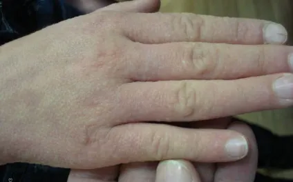 Прищі на руках у дитини - фото з поясненнями, і ногах, маленькі, червоні, білі, вище ліктя (фото) Прищі на руках у дитини - фото з поясненнями, і ногах, маленькі, червоні, білі, вище ліктя