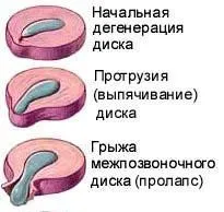 Протрузія міжхребцевих дисків, можливі наслідки хвороби (міжхребцевих) Протрузія міжхребцевих дисків, можливі наслідки хвороби