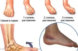 Розтягнення зв'язок стопи симптоми і лікування (стопи) Розтягнення зв'язок стопи симптоми і лікування