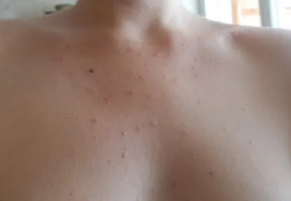 Робочий метод лікування акне на тілі, грудях, спині, шиї (лікування) Робочий метод лікування акне на тілі, грудях, спині, шиї