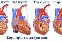 Реабілітація після аорто-коронарного шунтування (шунтування) Реабілітація після аорто-коронарного шунтування