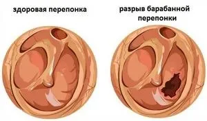 Розрив барабанної перетинки як виявляється і лікується (лікується) Розрив барабанної перетинки як виявляється і лікується