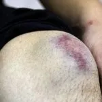 Ретракция кров'яного згустку 1 (кров'яного) Ретракция кров'яного згустку 1